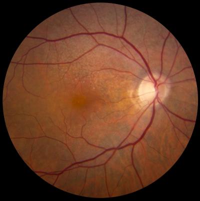 A fundus photo of a patient with reticular pseudodrusen shows a giraffe-like macular pattern.