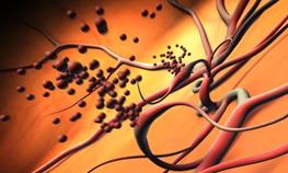 Animation of abnormal blood vessels bleeding into the center of the eye due to proliferative diabetic retinopathy. Photo credit: National Eye Institute. Watch video.