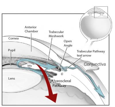 Aqueous humor flows out of the anterior chamber through the open angle where the cornea meets the iris. The open angle consists of two routes: the conventional, trabecular pathway, which includes a spongy layer called the trabecular meshwork, and the non-conventional, uveoscleral pathway, through the ciliary muscle that controls the eye’s focusing mechanism. The majority of fluid flows out via the trabecular pathway, which acts like a one-way valve. About a third of the fluid exits through the uveoscleral p