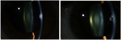 The level of alpha-crystallin in the eye declines as cataract progresses. Left: The eye of a patient with an early cataract. Right: After 20 months, the same eye has a clinically significant cataract. During that period, the level of alpha-crystallin decreased by more than 94 percent.