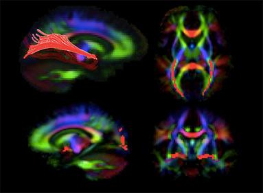 Images of the brain generated by diffusion tensor imaging, a type of MRI. The red highlights show visual pathways in the brain that deteriorate in patients with LCA, but appear to improve with gene therapy to the retina. Credit: Dr. Manzar Ashtari, University of Pennsylvania.