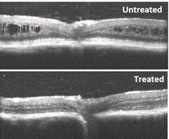 Cross-sectional images of retina from retinoschisin-deficient mice, untreated and treated with XLRS gene therapy.