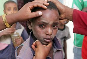 Children who slept near a cooking fire were four times as likely to develop severe trachoma compared with children who slept in ventilated rooms without cooking fires. This child’s severe trachoma led to loss of vision in his left eye. Photo courtesy of Raul Vasquez/Orbis.