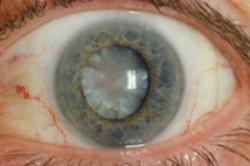 An age-related cataract. Credit: National Eye Institute.