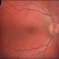 Fundus photo 
