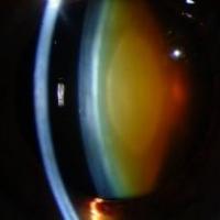 Brunescent nuclear cataract