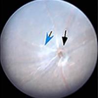 Eyes with autoimmune uveitis show increased inflammatory cells in the eye (indicated by arrows). Treatment with p35 reduces this inflammatory response.  Credit: Charles Egwuagu.
