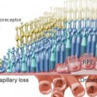 Diagram of RPE cell loss