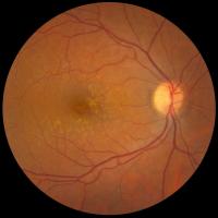 Fundus photo showing medium drusen
