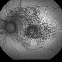 Image of retina