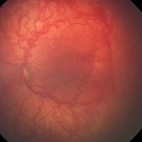 Severe ROP Avastin candidate
