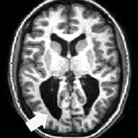 Cross-section of fMRI brain scan with arrow pointing to dark area