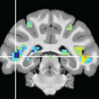 Slice of brain scan showing highlights in the cortex