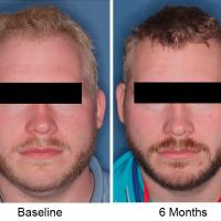 Side-by-side photos of trial participant before and after treatment