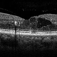 OCT image of a retina