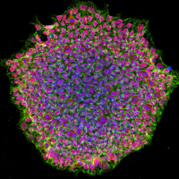 Group of cells tinted purple in the middle and pink at the edges representing a human induced stem cell colony from a patient with albinism.