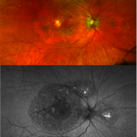 Images of a patient eye with new TIMP3 maculopathy