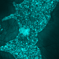 Image of an eye with choroideremia, characterized by enlarged RPE cells. 