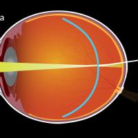 illustration showing axial elongation of the eye from myopia