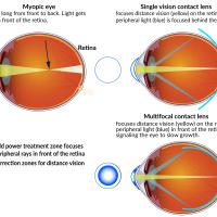 A myopic eye grows too long from front to back. Light gets focused in front of the retina. Single-vision contact lenses focus distance vision on the retina, but peripheral light is focused behind the retina. Multifocal contact lenses focus distance vision on the retina and peripheral light in front of the retina, signaling the eye to slow growth.Multifocal contact lenses are concentric circles consisting of an add power treatment zone in the outer rings that focuses peripheral rays in front of the retina.