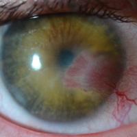 eye with herpes stromal keratitis