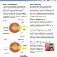 Farsightedness (Hyperopia) thumbnail