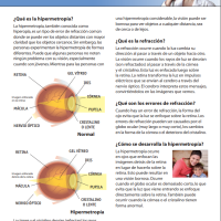 La Hipermetropia thumbnail