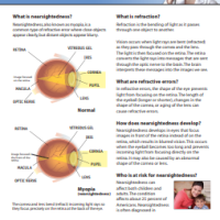 Myopia nearsightedness thumbnail