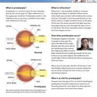 Presbyopia thumbnail