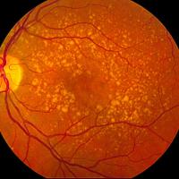 Fundus photograph of age-related macular degeneration showing drusen.