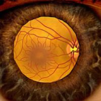Illustration showing the retina as seen through a dilated pupil.