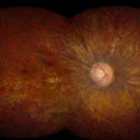 LCA is an inherited disorder that causes vision loss in childhood. It primarily affects the functioning of the retina, the light-sensitive tissue at the back of the eye, as shown here. Photo credit: National Eye Institute