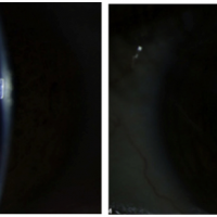 The level of alpha-crystallin in the eye declines as cataract progresses. Left: The eye of a patient with an early cataract. Right: After 20 months, the same eye has a clinically significant cataract. During that period, the level of alpha-crystallin decreased by more than 94 percent.