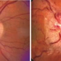 On the left is a normal optic nerve (light circle at center) and on the right is the optic nerve swelling seen in IIH. Courtesy of Dr. Michael Wall, University of Iowa.